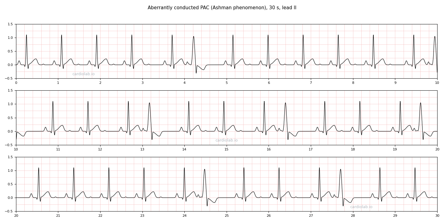 30 seconds of sinus rhythm with aberrantly conducted premature atrial contractions in lead II: each wide early beat follows a long cycle and a short coupling interval and is preceded by a premature P wave.