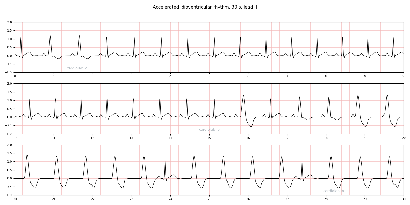 30 seconds of lead II in which sinus rhythm gives way to accelerated idioventricular rhythm: narrow sinus beats with P waves, then fusion beats, then wide regular complexes at 80 per minute with sinus P waves marching through them and occasional narrow capture beats.