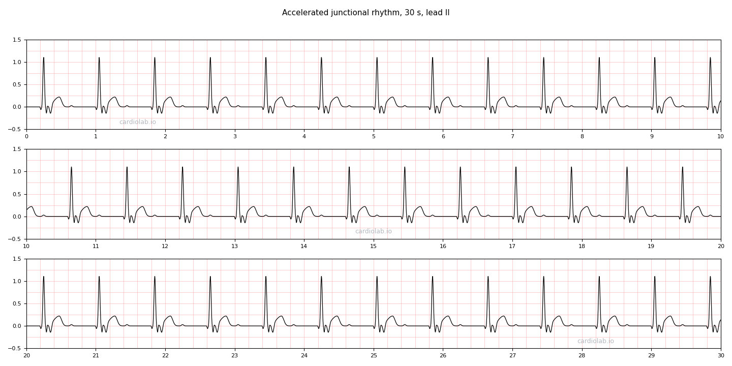 30 seconds of accelerated junctional rhythm in lead II: a regular narrow-complex rhythm at 75 per minute with no P wave before any QRS and an inverted retrograde P wave in the ST segment after each one.
