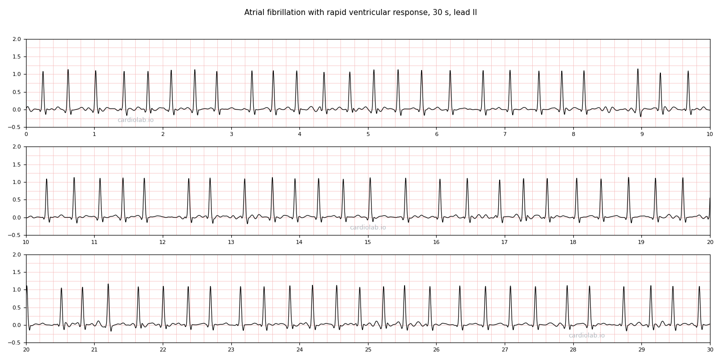 30 seconds of atrial fibrillation with a rapid ventricular response in lead II: narrow QRS complexes at about 152 per minute, irregularly irregular but close enough together to look almost regular, over a fibrillatory baseline with no P waves.