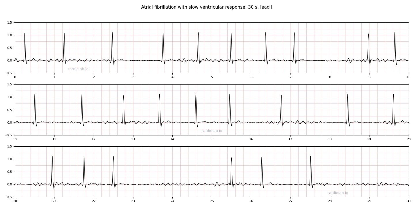 30 seconds of atrial fibrillation with a slow ventricular response in lead II: narrow QRS complexes at about 53 per minute, separated by long gaps of random length, up to 3 seconds, over a fibrillatory baseline with no P waves.