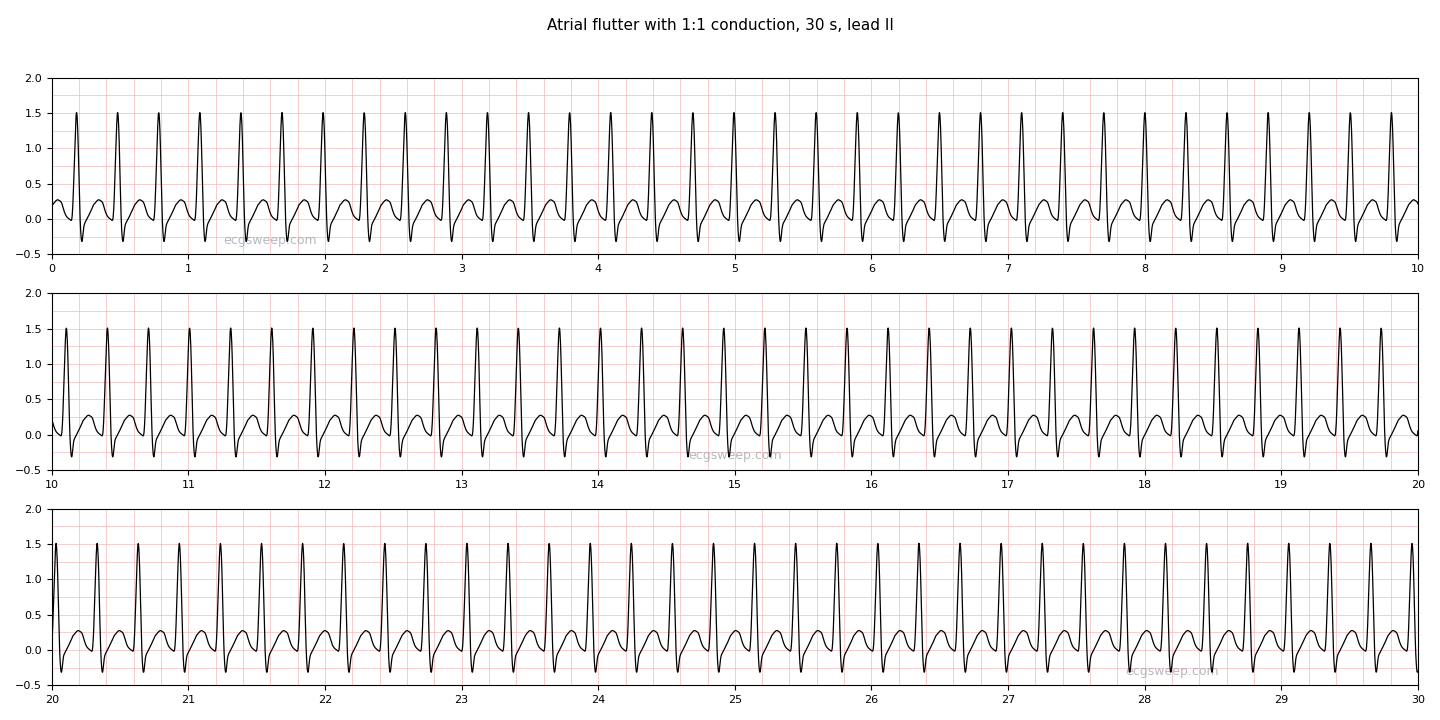 30 seconds of atrial flutter with 1:1 conduction in lead II: a regular narrow-complex tachycardia at about 200 per minute, with no flat baseline and the flutter waves hidden in the QRS and T.