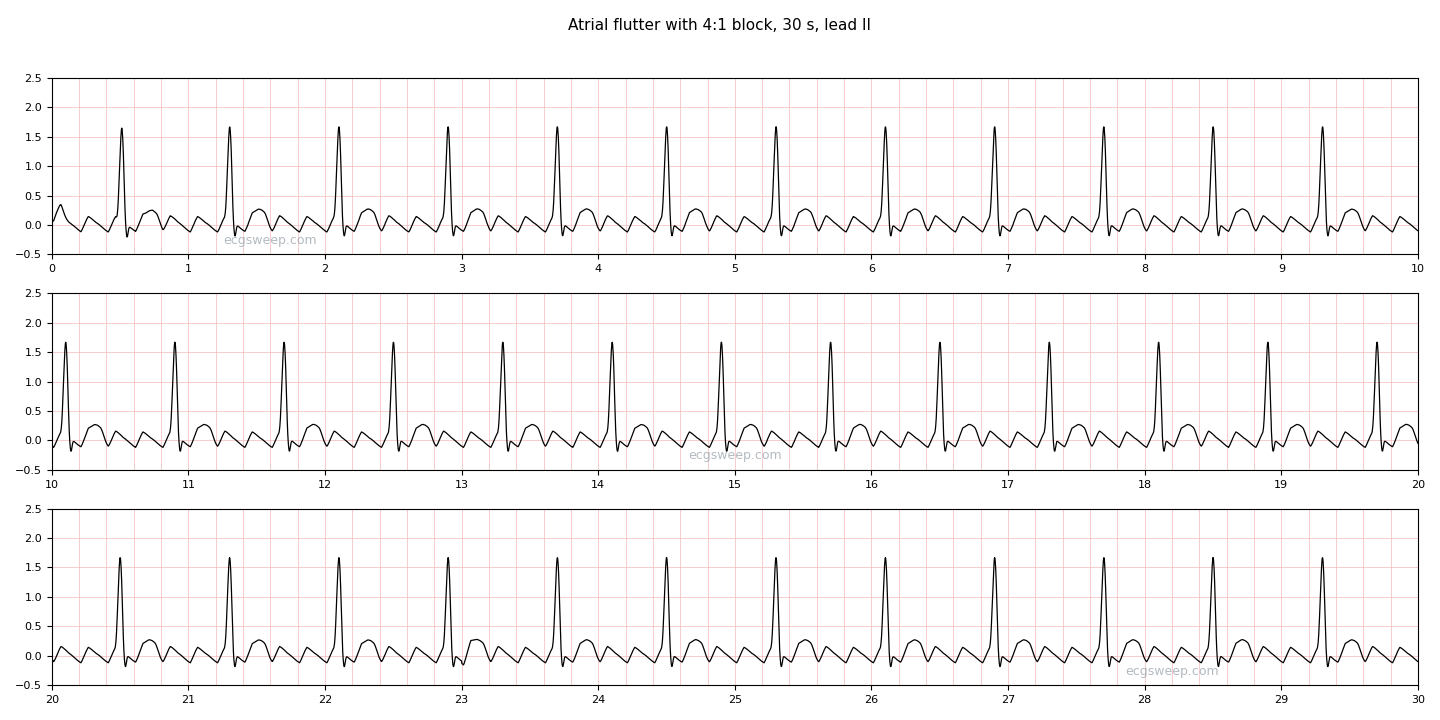 30 seconds of atrial flutter with 4:1 block in lead II: a regular narrow-complex rhythm at 75 per minute, with three flutter waves in plain view between each pair of beats.