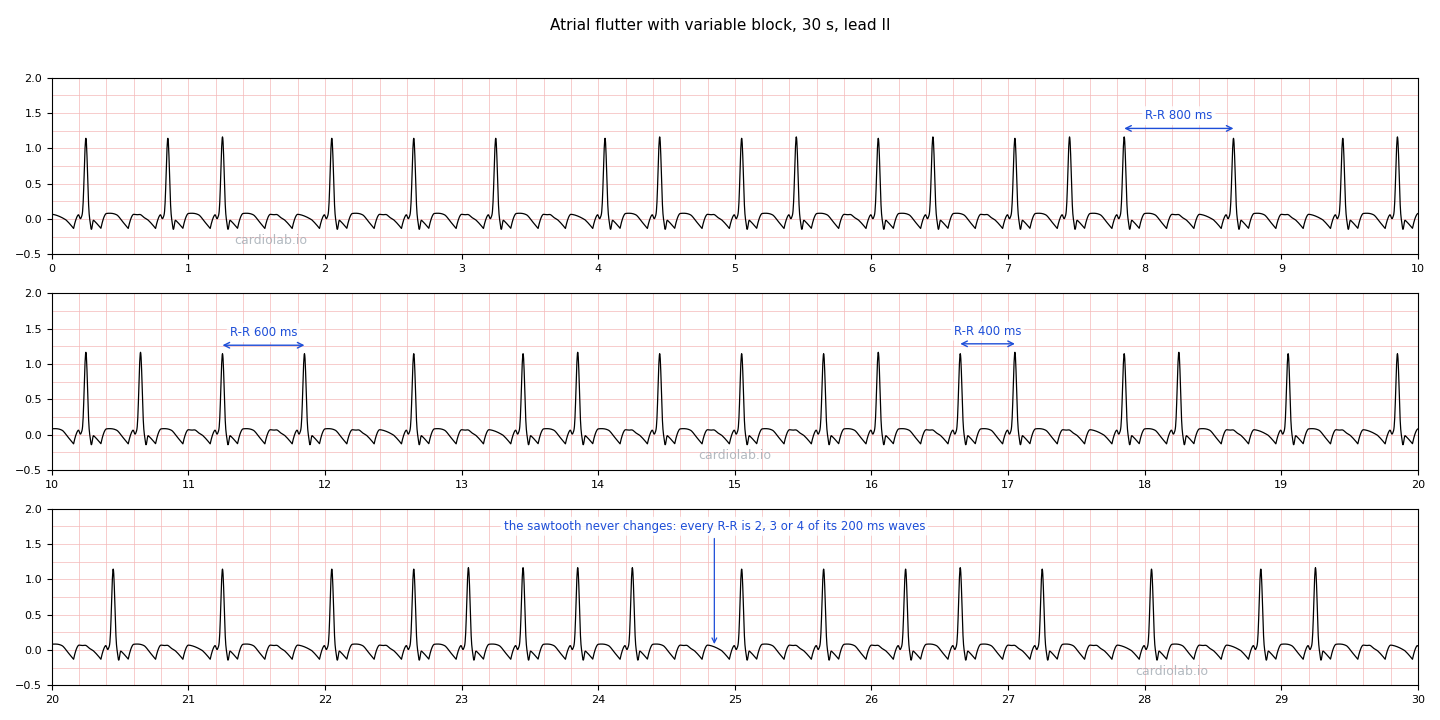 The same flutter strip, annotated: three R-R intervals are bracketed at 800, 600 and 400 ms, and an arrow points to the unchanging sawtooth, whose 200 ms waves divide every interval exactly.