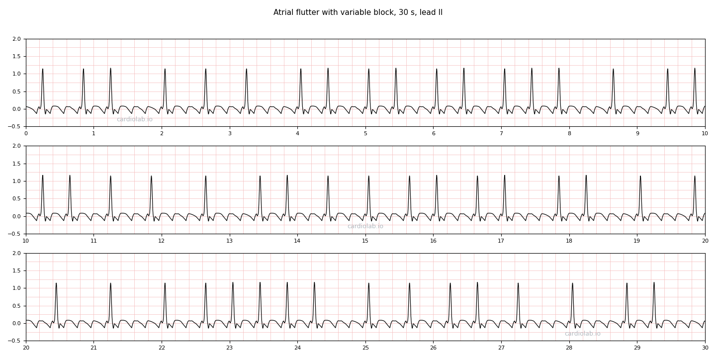 30 seconds of atrial flutter with variable block in lead II: an irregular narrow-complex rhythm averaging about 100 per minute over a regular sawtooth baseline, with R-R intervals of 400, 600 or 800 ms and nothing in between.