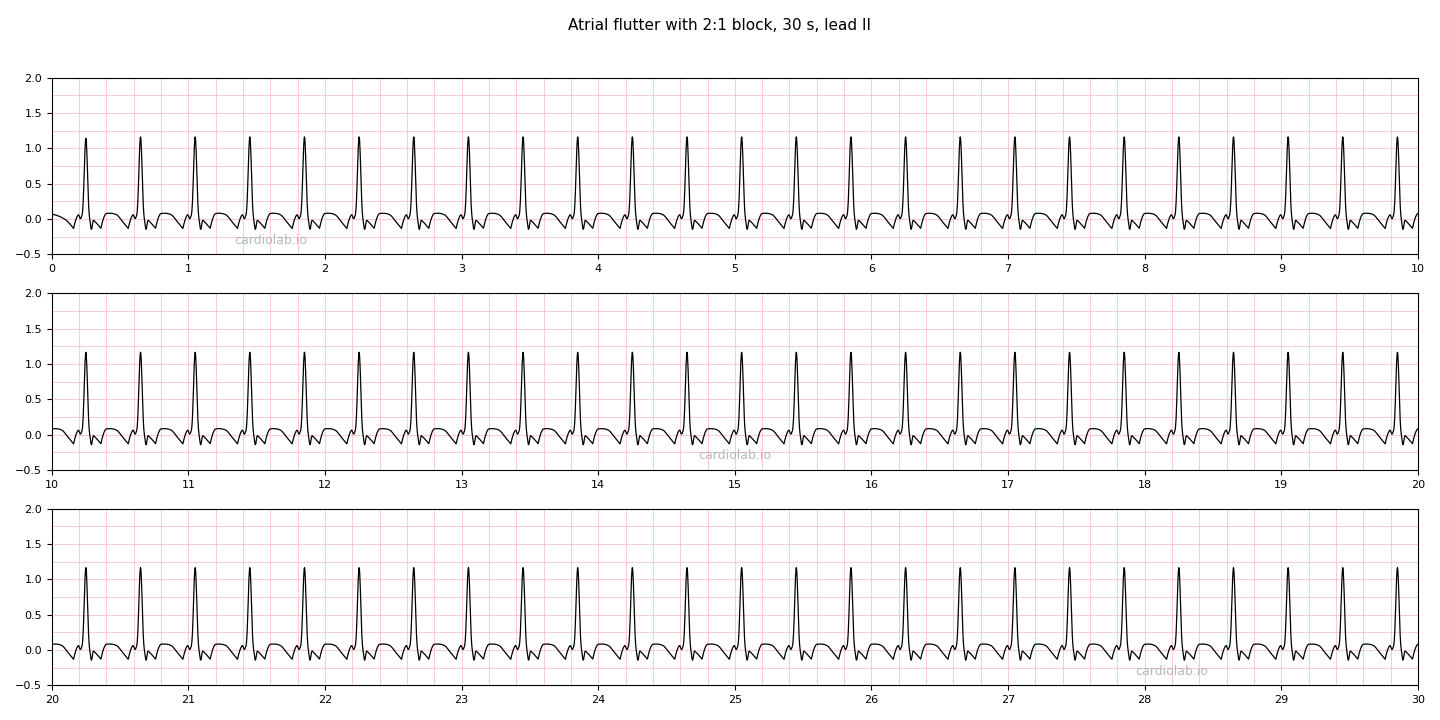 30 seconds of typical atrial flutter with 2:1 block in lead II: a regular narrow-complex tachycardia at 150 per minute over a continuous sawtooth baseline, with one flutter wave between beats and another hidden in each ST segment.