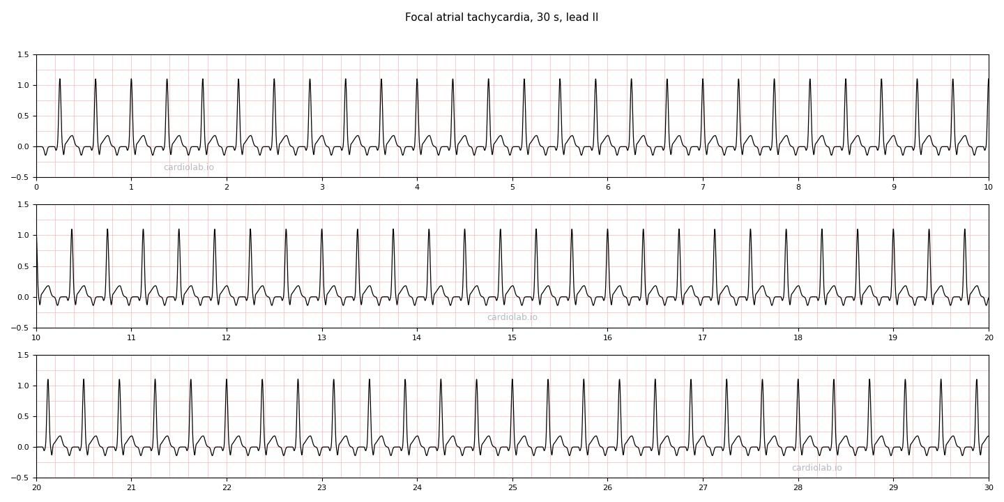 30 seconds of focal atrial tachycardia in lead II: a regular narrow-complex tachycardia at 160 per minute, with an inverted P wave before every QRS and a flat baseline between each P and its QRS.