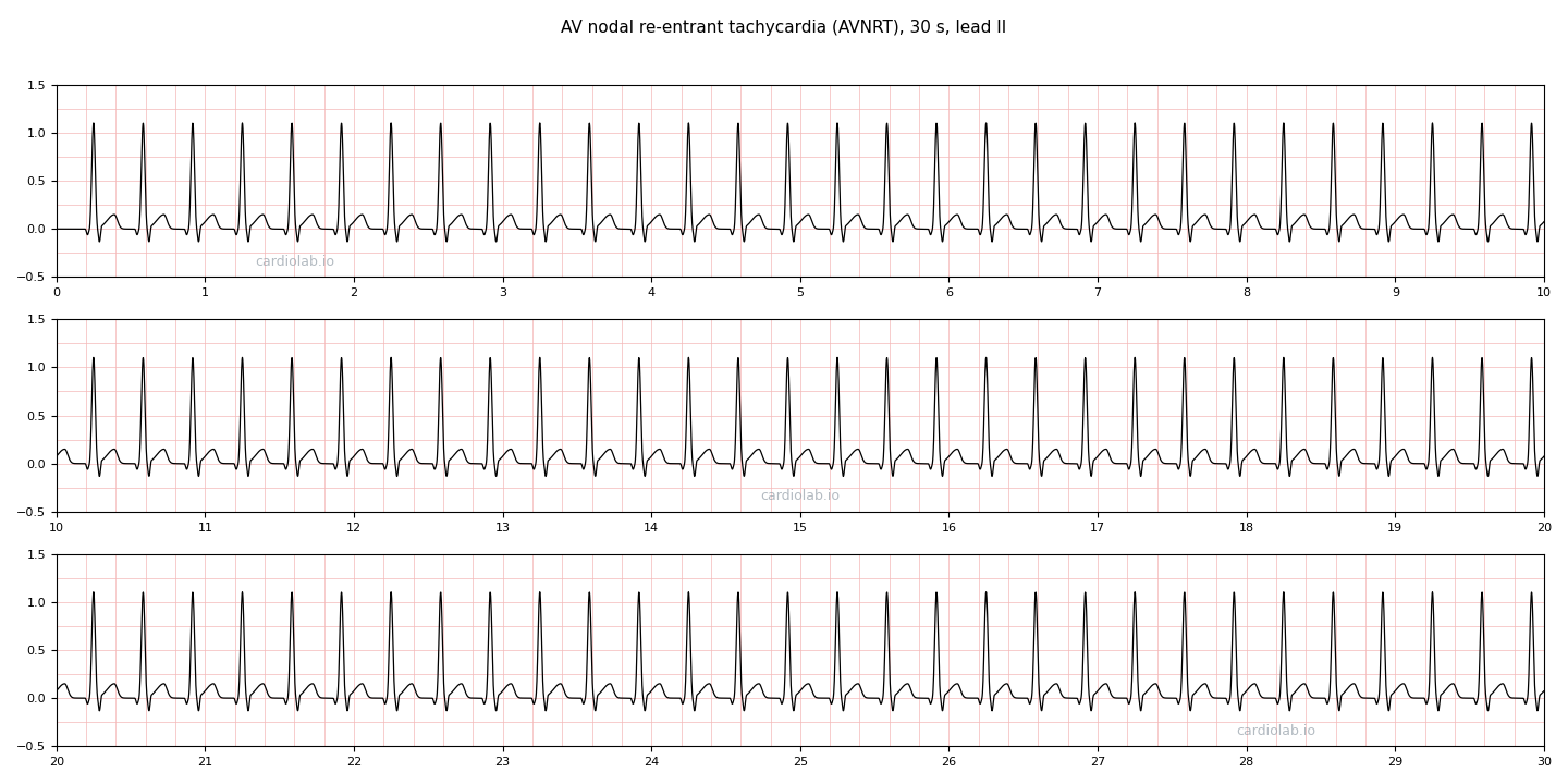 30 seconds of AVNRT in lead II: a regular narrow-complex tachycardia at 180 per minute with no visible P waves and no deflection between the QRS and the T wave.