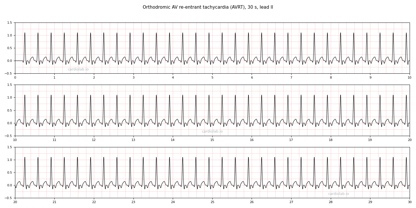 30 seconds of orthodromic AVRT in lead II: a regular narrow-complex tachycardia at 180 per minute with a small negative retrograde P wave on the ST segment of every beat.