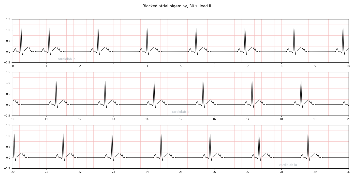 30 seconds of blocked atrial bigeminy in lead II: a regular narrow-complex rhythm at 42 per minute that looks like sinus bradycardia, but every T wave carries a second hump, a premature P wave that is not conducted.