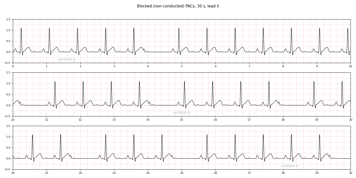 30 seconds of sinus rhythm at 72 per minute with blocked premature atrial contractions in lead II: occasional pauses of 1333 ms, each preceded by a T wave deformed by a second hump, the premature P that was not conducted.
