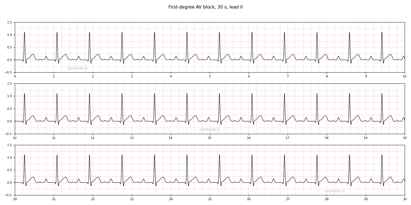 30 seconds of first-degree AV block in lead II: regular sinus rhythm at 72 per minute, a P wave before every QRS, and a long PR interval that is the same on every beat.
