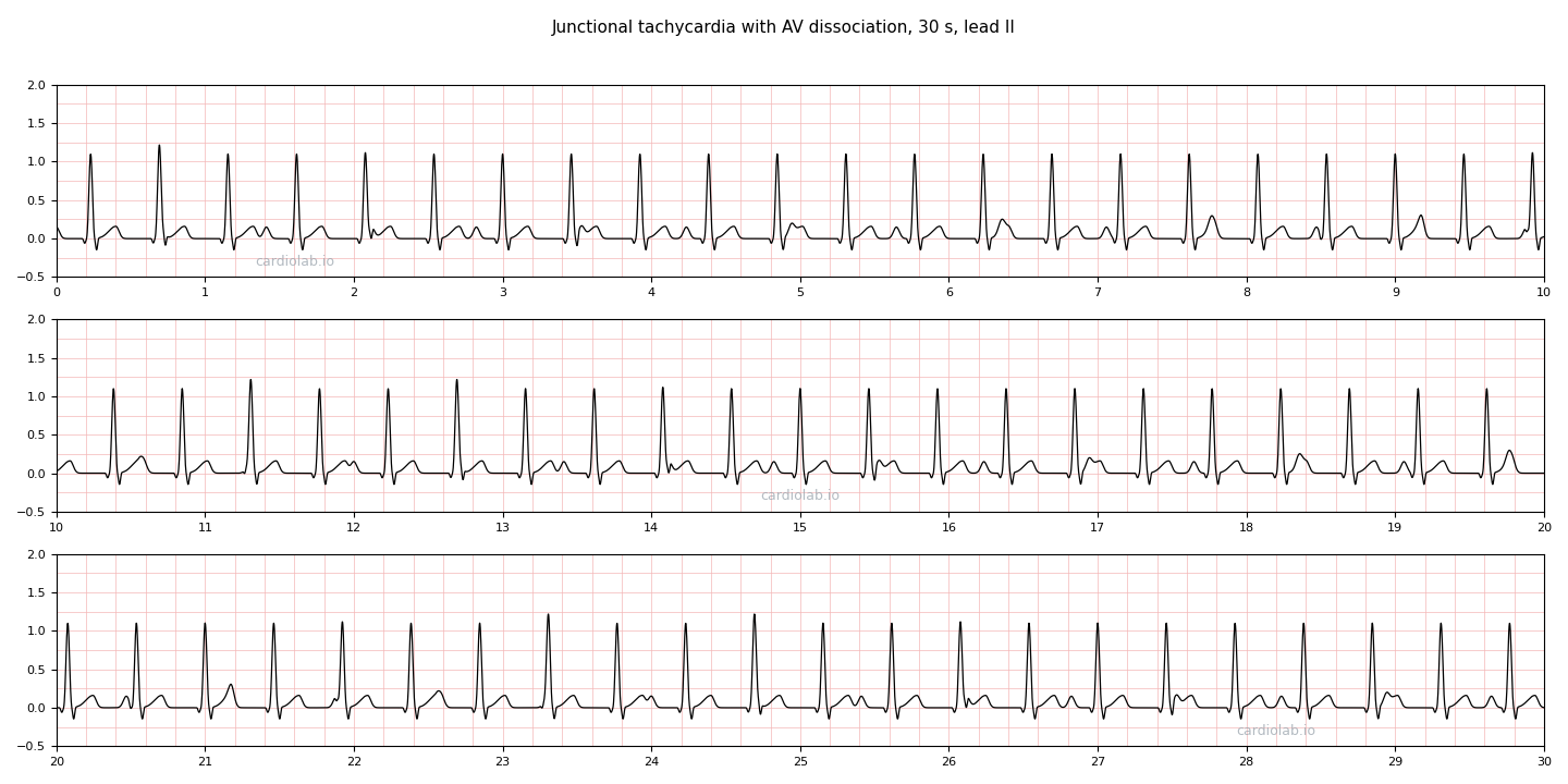 30 seconds of junctional tachycardia in lead II: a regular narrow-complex tachycardia at 130 per minute with upright P waves marching independently at 85 per minute, sometimes in front of a QRS, sometimes inside one, sometimes between them.