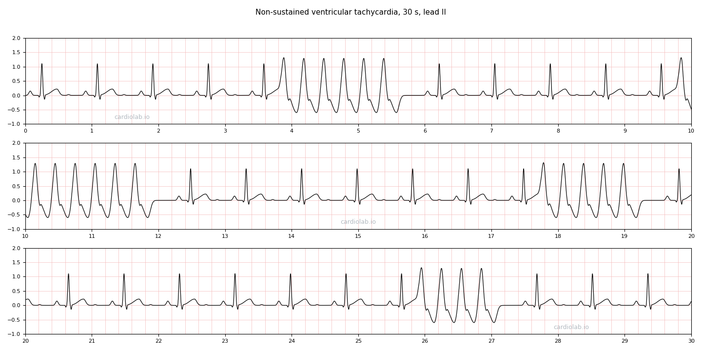 30 seconds of sinus rhythm in lead II interrupted by four short runs of wide identical complexes at 200 per minute, each of which stops on its own.