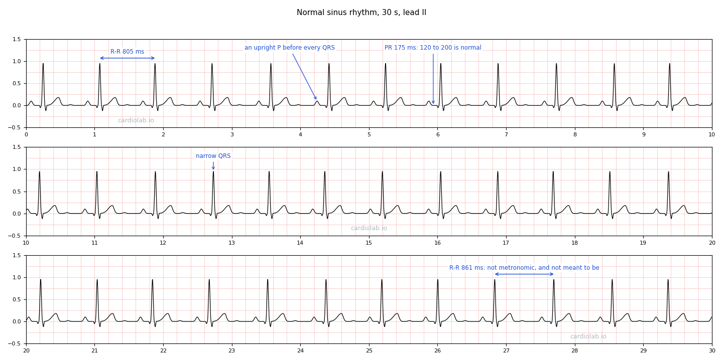 The same normal sinus strip, annotated: the shortest R-R interval (805 ms) and the longest (861 ms) bracketed, an arrow to the upright P wave before a QRS, an arrow to the PR interval (175 ms), and an arrow to a narrow QRS.