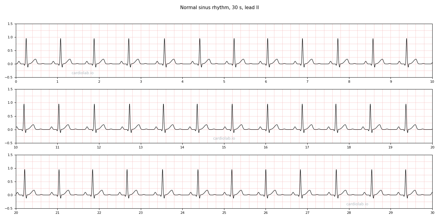 30 seconds of normal sinus rhythm in lead II at 72 per minute: an upright P wave before every narrow QRS, a normal fixed PR interval, and R-R intervals that vary only slightly.