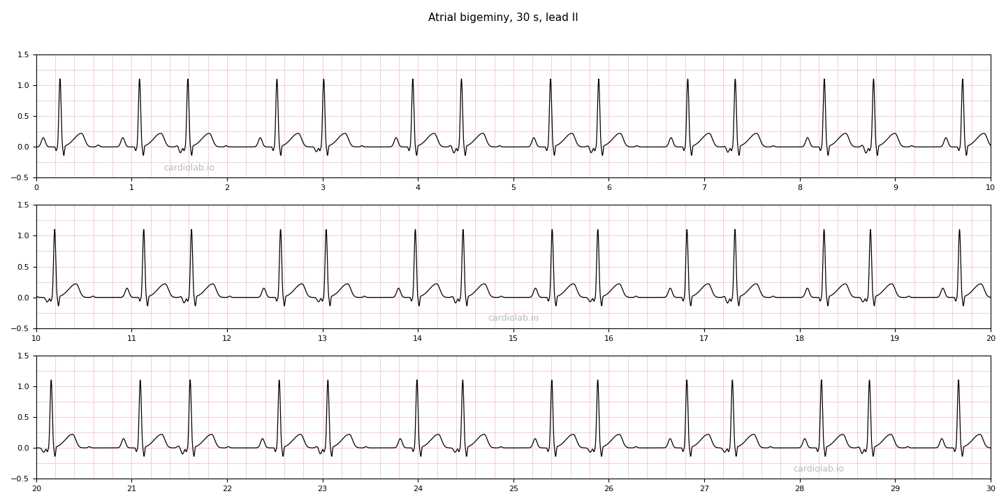 30 seconds of atrial bigeminy in lead II: sinus beats and premature atrial contractions alternating one for one, each PAC early with an inverted P wave and a narrow QRS, giving a long-short rhythm.