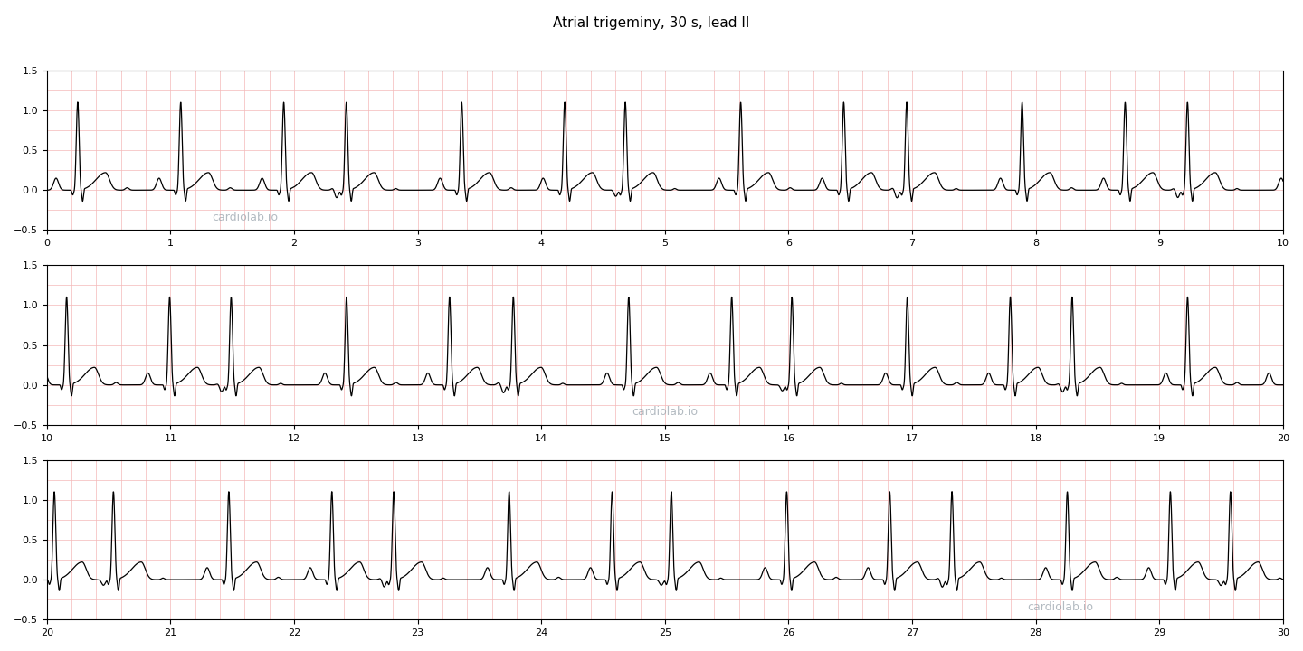 30 seconds of atrial trigeminy in lead II: two sinus beats followed by one premature atrial contraction, repeating, each PAC early with an inverted P wave and a narrow QRS.