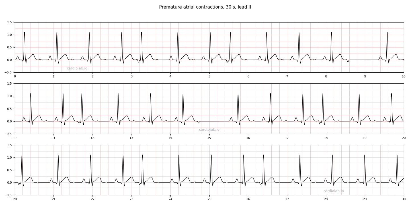 30 seconds of sinus rhythm at 72 per minute with premature atrial contractions in lead II: early narrow beats, each preceded by an inverted P wave and followed by a pause shorter than two sinus cycles.
