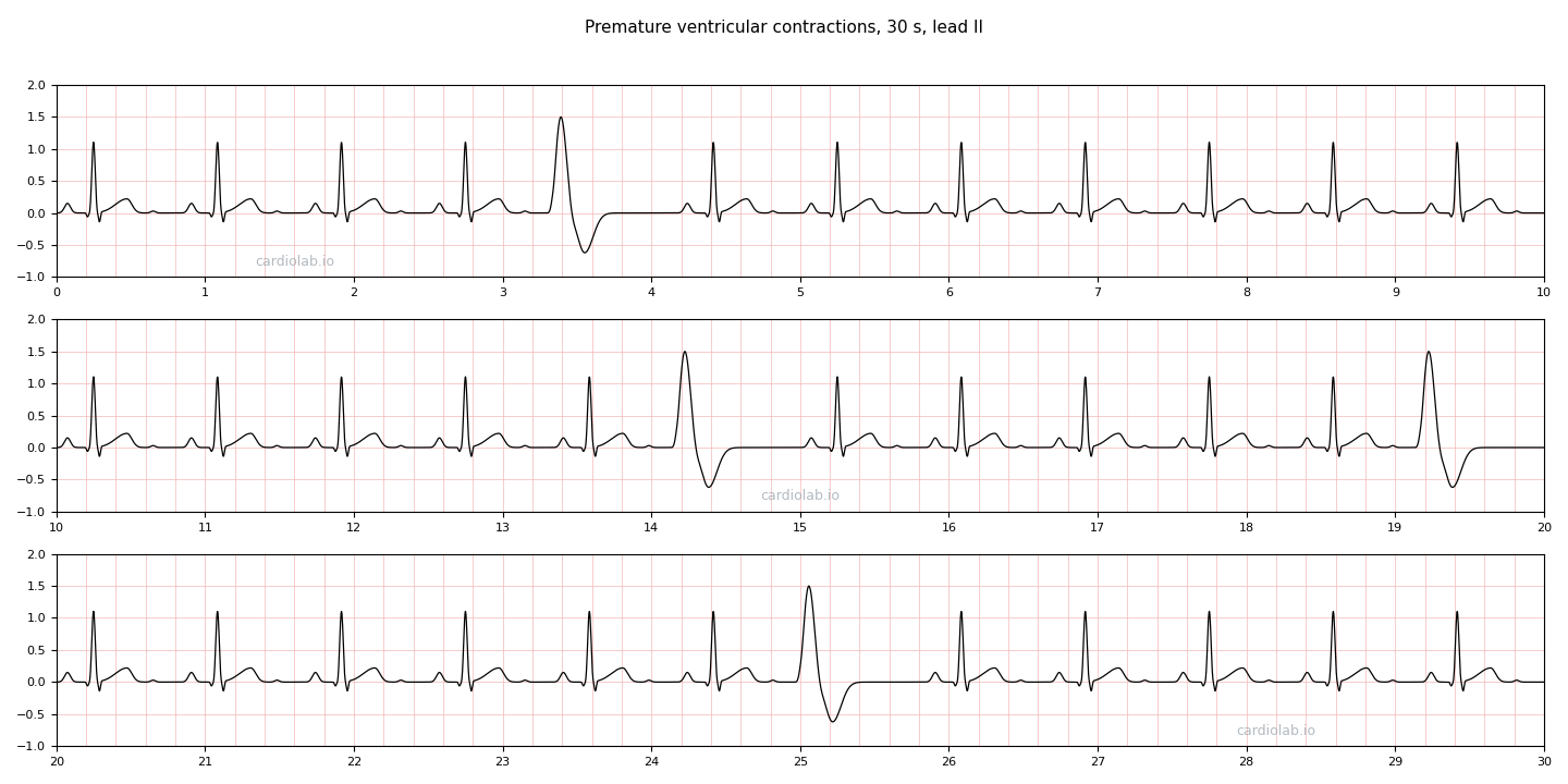 30 seconds of sinus rhythm at 72 per minute with premature ventricular contractions in lead II: occasional early, wide, bizarre beats with no P wave of their own and a T wave pointing the opposite way, each followed by a fully compensatory pause.