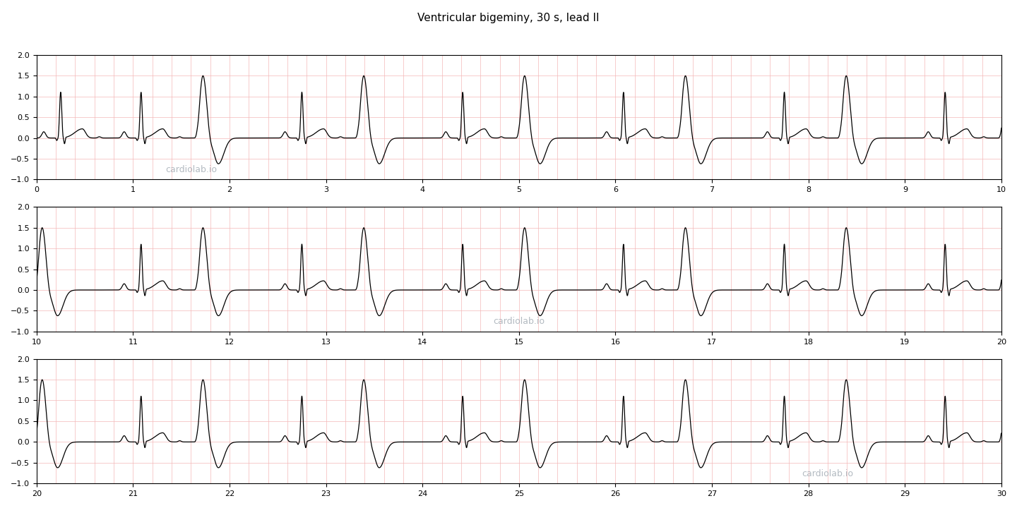 30 seconds of ventricular bigeminy in lead II: narrow sinus beats and wide premature ventricular contractions alternating one for one, each PVC at the same coupling interval and followed by a fully compensatory pause.