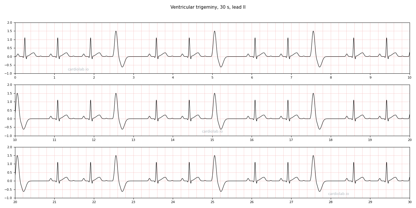 30 seconds of ventricular trigeminy in lead II: two narrow sinus beats followed by one wide premature ventricular contraction, repeating, each PVC at the same coupling interval and followed by a fully compensatory pause.