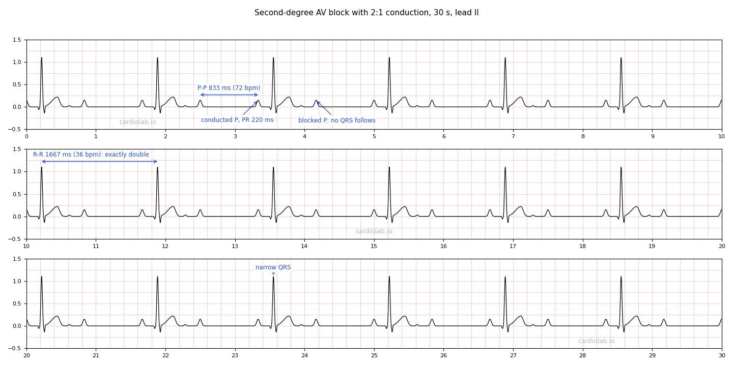 The same 2:1 block strip, annotated: a P-P interval bracketed at 833 ms (72 bpm) between two consecutive P waves, arrows naming one conducted P (PR 220 ms) and the blocked P after it, an R-R interval bracketed at 1667 ms (36 bpm), and an arrow to a narrow QRS.