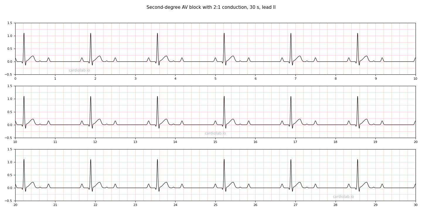 30 seconds of 2:1 AV block in lead II: sinus P waves at 72 per minute, only every second one followed by a narrow QRS, so the ventricular rate is 36 per minute, with each blocked P sitting on the baseline after the T wave.