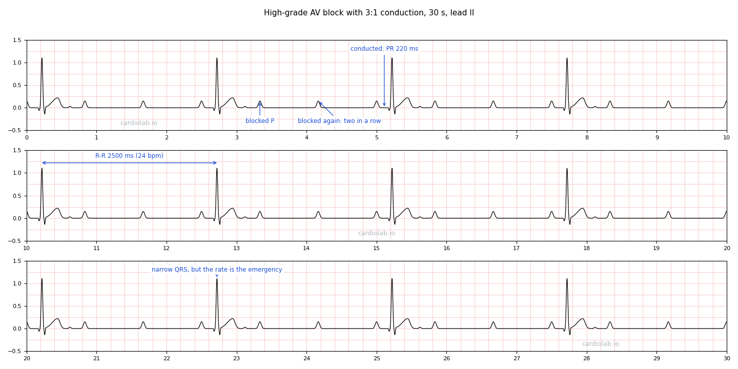 The same 3:1 block strip, annotated: arrows to two consecutive blocked P waves, an arrow to the PR of the conducted beat (220 ms), an R-R interval bracketed at 2500 ms (24 bpm), and an arrow to a narrow QRS.