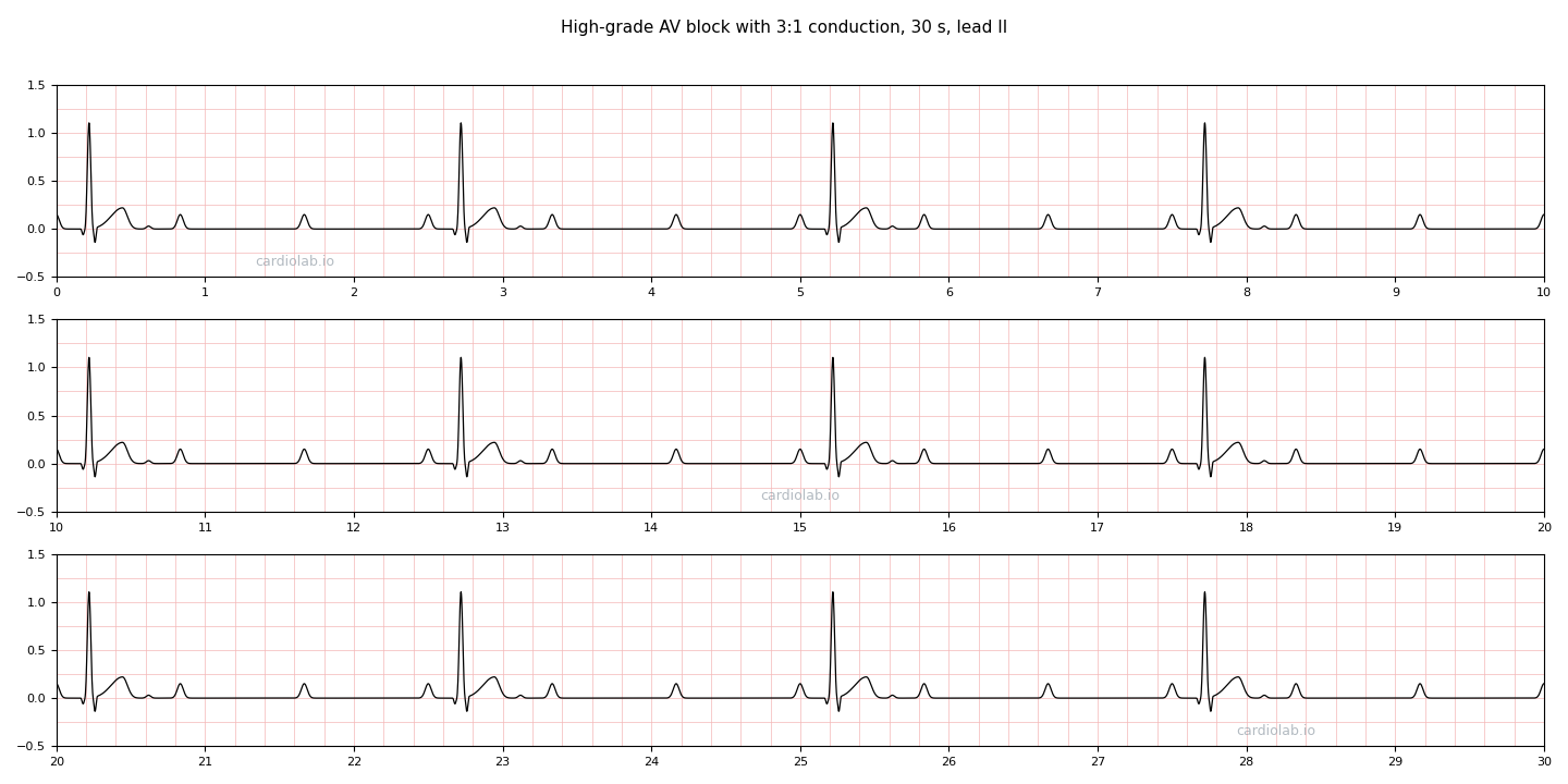 30 seconds of high-grade AV block with 3:1 conduction in lead II: sinus P waves at 72 per minute, only every third one followed by a narrow QRS, so the ventricular rate is 24 per minute, with two blocked P waves in a row between beats.