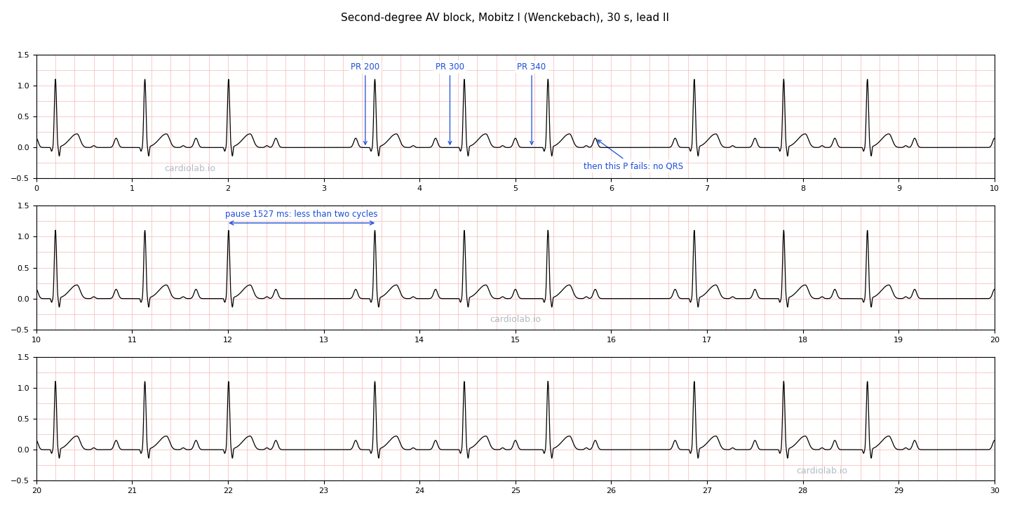 The same Wenckebach strip, annotated: arrows to the PR interval of three consecutive beats reading 200, 300 and 340 ms, an arrow to the next P wave, which is not followed by a QRS, and a bracket over a pause reading 1527 ms.