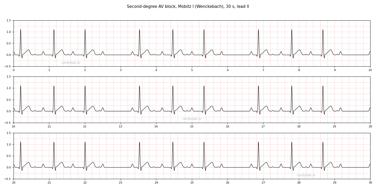 30 seconds of Mobitz I second-degree AV block in lead II: sinus P waves at a steady 72 per minute, with the PR interval lengthening over three beats until a P wave is not conducted, giving grouped beating with a pause after every third QRS.