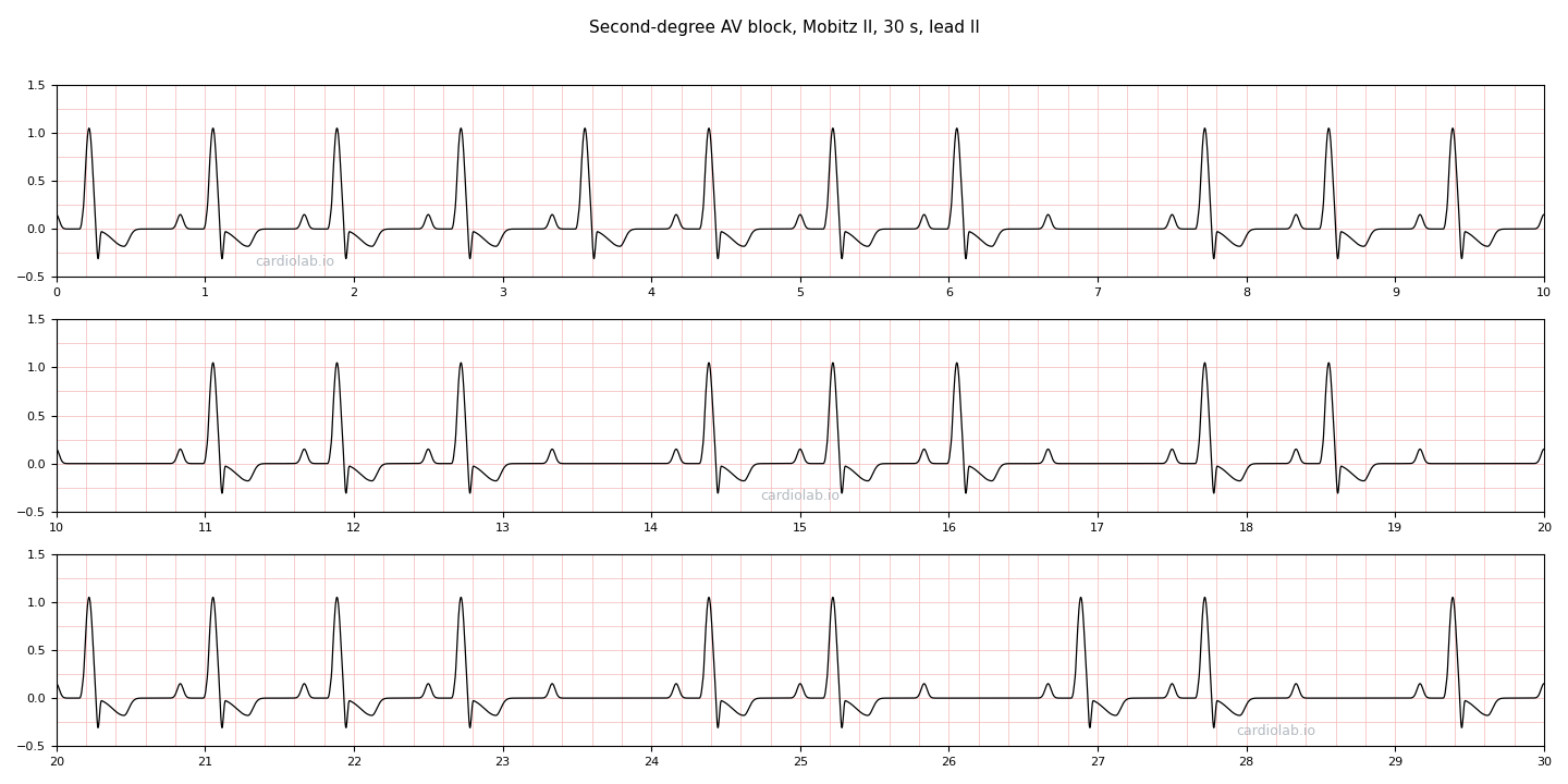 30 seconds of Mobitz II second-degree AV block in lead II: sinus P waves at 72 per minute, a fixed PR interval on every conducted beat, wide QRS complexes, and occasional P waves that are not conducted without any warning beforehand.