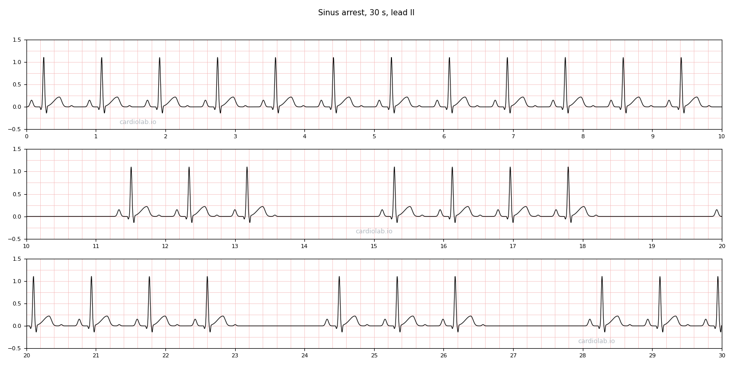 30 seconds of sinus rhythm at 72 per minute in lead II interrupted by pauses of about two seconds, each completely flat with no P wave or QRS, and each a different length that is not a whole number of sinus cycles.
