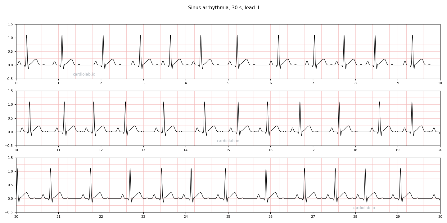 30 seconds of sinus arrhythmia in lead II: an upright P wave before every narrow QRS with a fixed PR interval, while the R-R intervals lengthen and shorten smoothly, repeating about every four seconds.