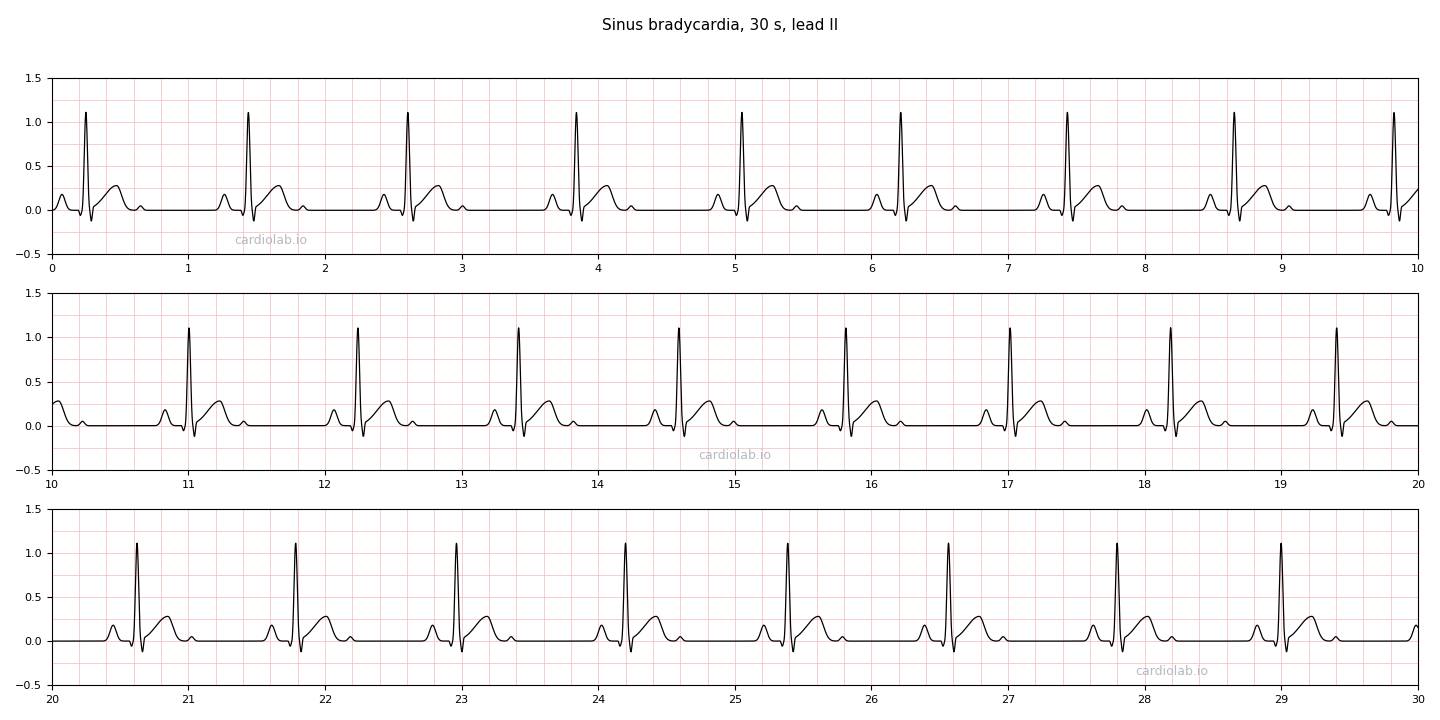 30 seconds of sinus bradycardia in lead II at 50 per minute: an upright P wave before every narrow QRS and a normal fixed PR interval, with the complexes simply further apart.