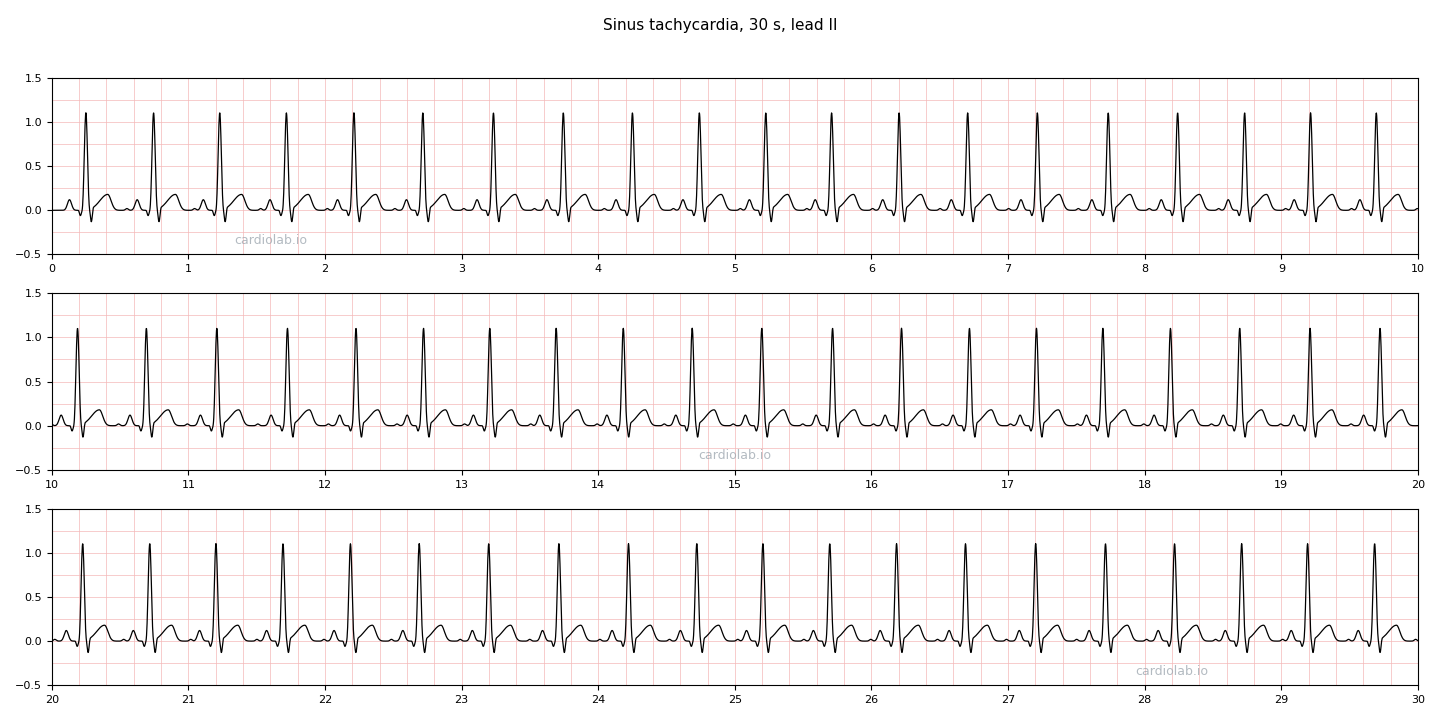 30 seconds of sinus tachycardia in lead II at 120 per minute: a regular narrow-complex rhythm with an upright P wave before every QRS, still clear of the preceding T wave.
