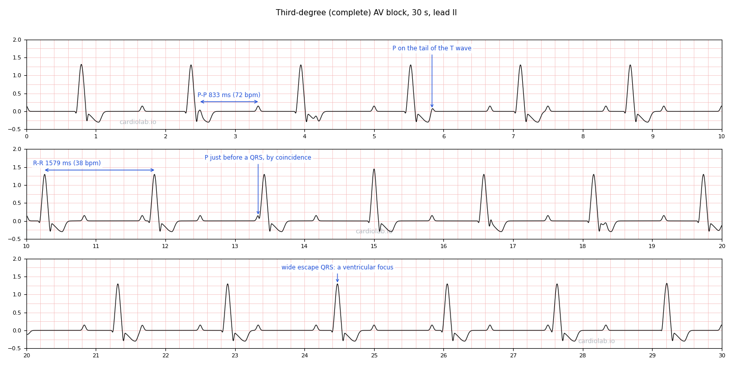 The same complete heart block strip, annotated: a P-P interval bracketed at 833 ms (72 bpm), an arrow to a P wave on the tail of a T wave, an R-R interval bracketed at 1579 ms (38 bpm), an arrow to a P wave falling just before a QRS by coincidence, and an arrow to a wide escape QRS.