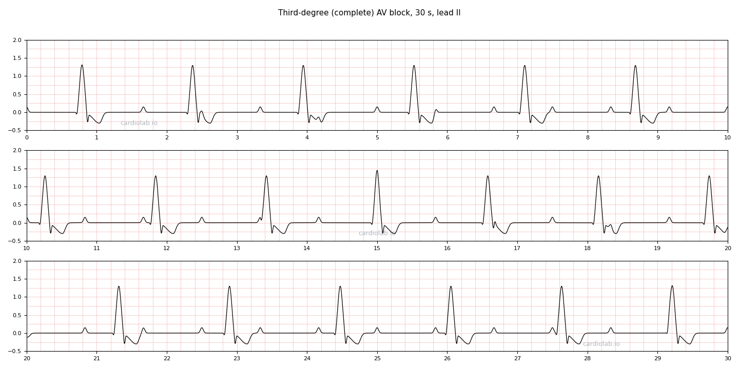 30 seconds of complete heart block in lead II: regular sinus P waves at 72 per minute and a separate, slower regular rhythm of wide QRS complexes at 38 per minute, with the P waves falling at random against the QRS complexes.