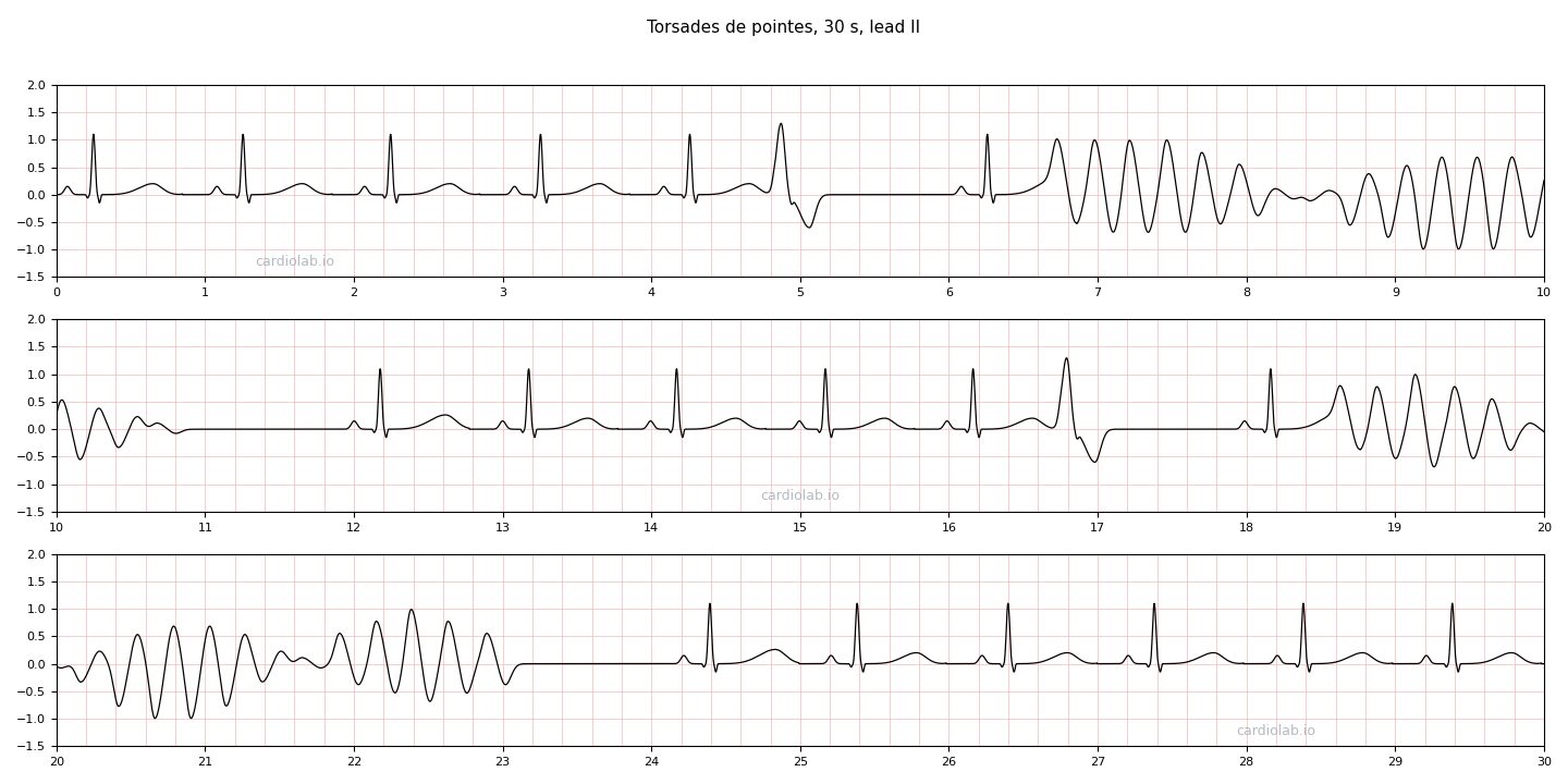 30 seconds of lead II with two runs of torsades de pointes over a sinus rhythm with a long QT: each run begins after a short-long-short sequence and its complexes swell, shrink and flip polarity as if twisting around the baseline, then stop on their own.