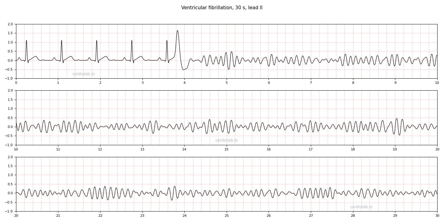 30 seconds of lead II in which a few sinus beats are interrupted by an early beat on a T wave, followed by coarse ventricular fibrillation: an irregular, chaotic undulation with no P waves, QRS complexes or T waves.