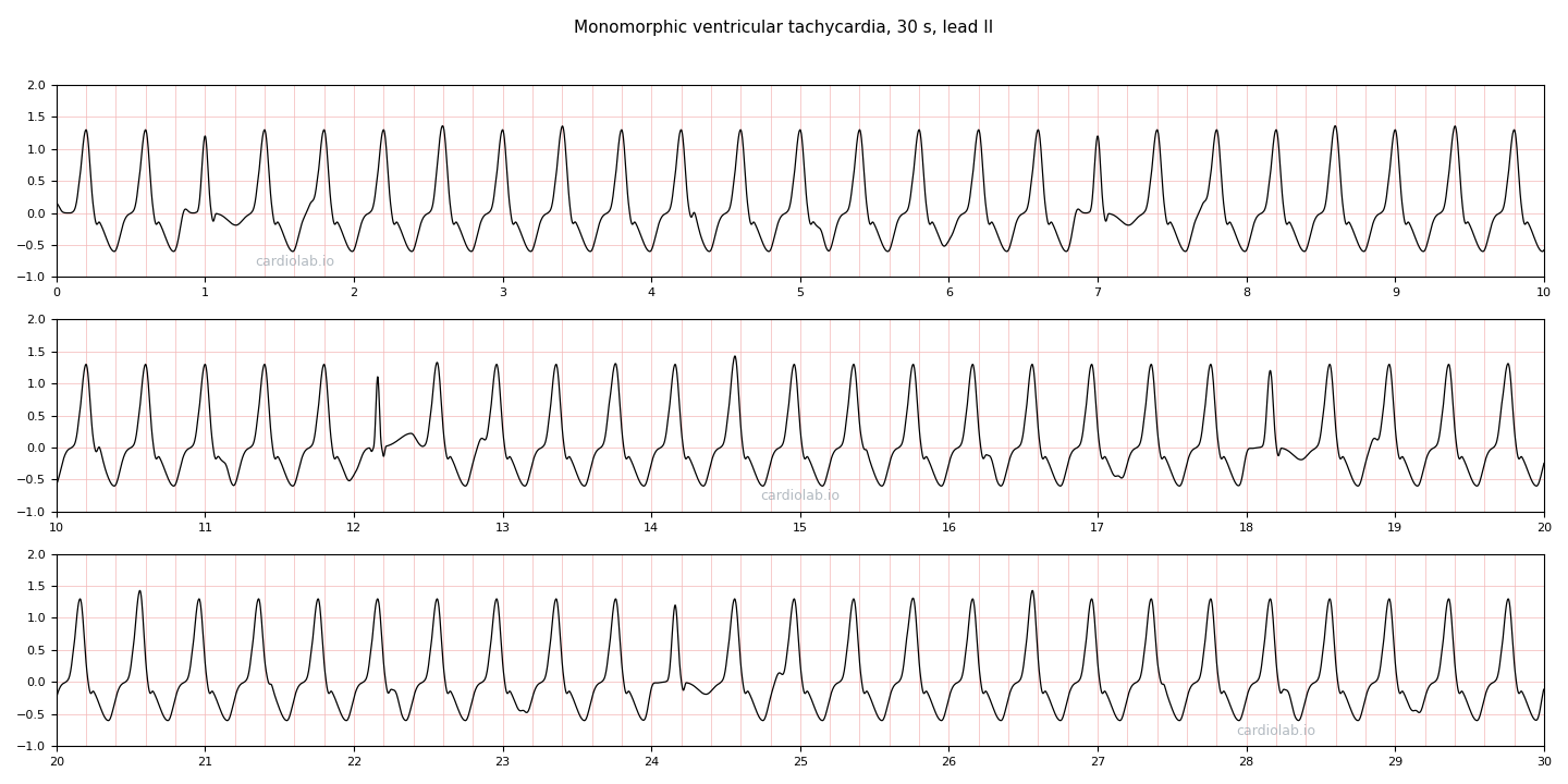 30 seconds of sustained monomorphic ventricular tachycardia in lead II: wide identical complexes at 150 per minute, with sinus P waves marching through them independently, occasional fusion beats and one narrow capture beat.