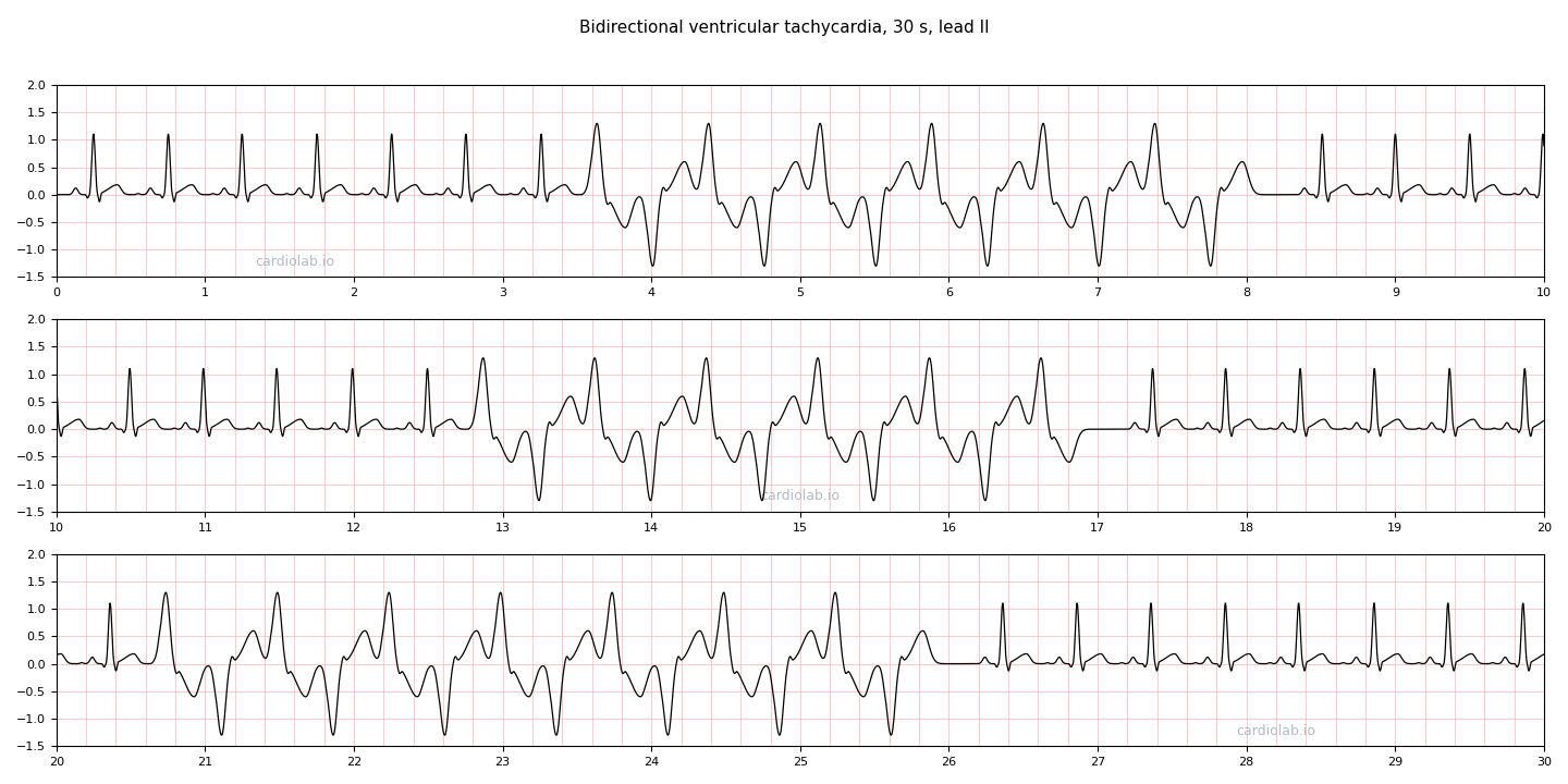30 seconds of lead II with three runs of bidirectional ventricular tachycardia over a sinus tachycardia of 120 per minute: in each run the wide complexes alternate upright and inverted, beat by beat, at a regular rate.