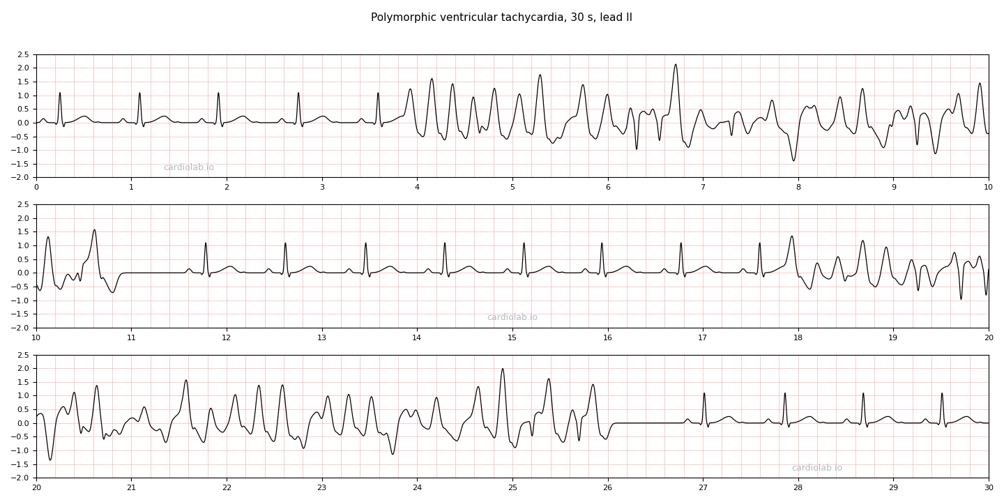 30 seconds of lead II with two runs of polymorphic ventricular tachycardia: sinus beats with a normal QT, then a single early beat on a T wave starting a fast, irregular run of complexes that each differ in height, width and direction, ending with a return to sinus rhythm.