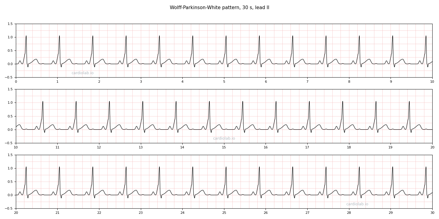 30 seconds of sinus rhythm with a Wolff-Parkinson-White pattern in lead II: regular at 75 per minute, an upright P wave, a short PR interval, and a QRS that starts with a slow slurred upstroke (the delta wave) before rising sharply.
